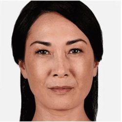 JUVÉDERM® VOLUMA® XC Before & After Patient #1655